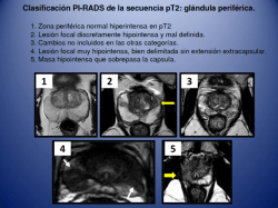 r Clasificación PI-RADS de la secuencia pT2: glándula periférica.