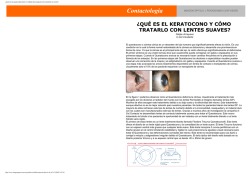 ¿QUÉ ES EL KERATOCONO Y CÓMO TRATARLO CON LENTES