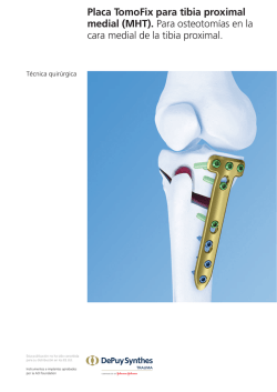 Placa TomoFix para tibia proximal medial (MHT