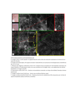 EPITELIOMA BASOCELULAR MICRONODULAR A. Im agen