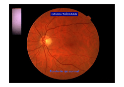 retinopatia diabetica no proliferante leve, con