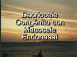 Dacriocele con mucocele endonasal Versión PDF