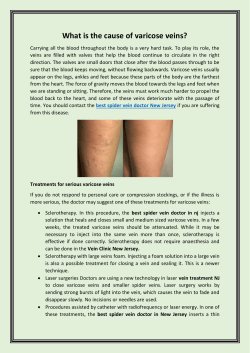 What is the cause of varicose veins